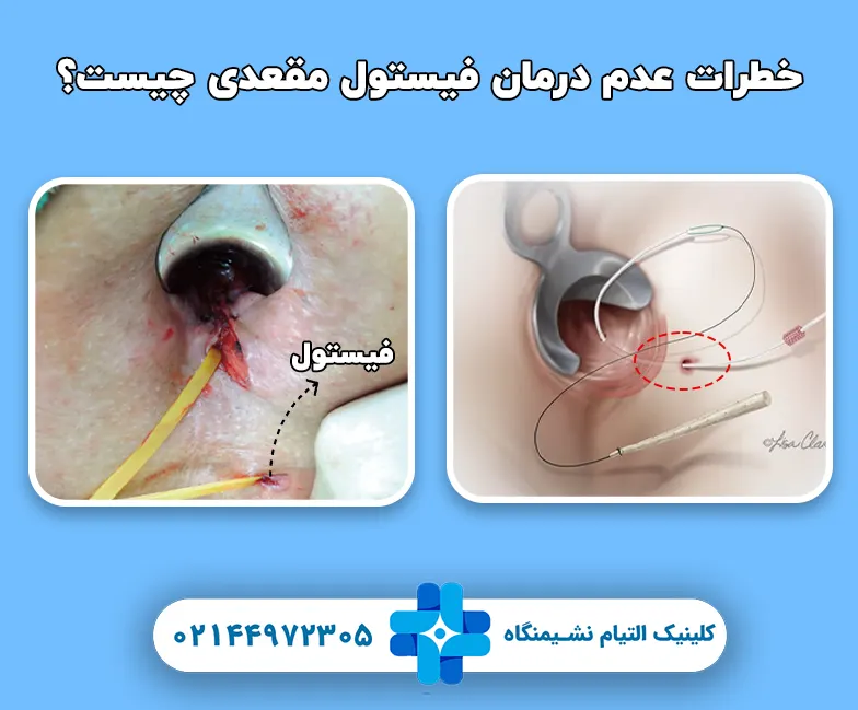 خطرات عدم درمان فیستول مقعدی چیست؟