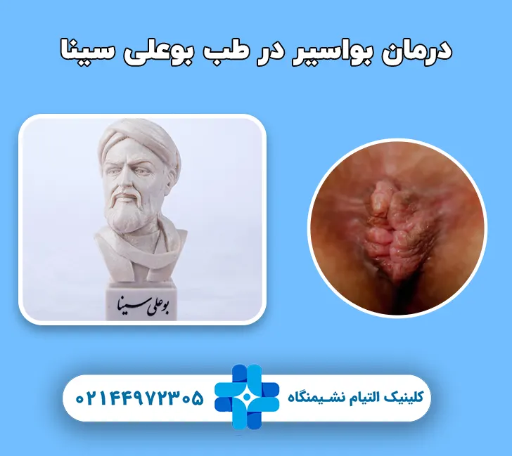 درمان بواسیر در طب بوعلی سینا