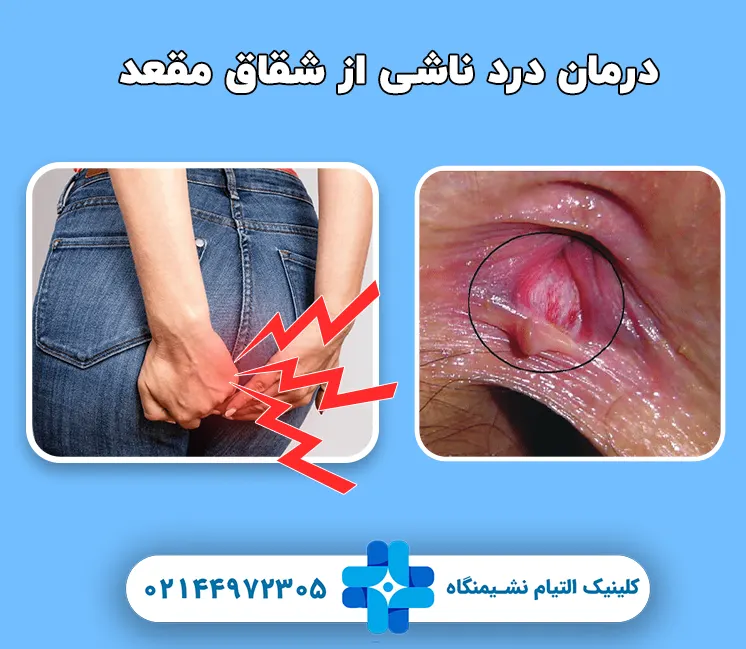 درمان درد شقاق مقعدی