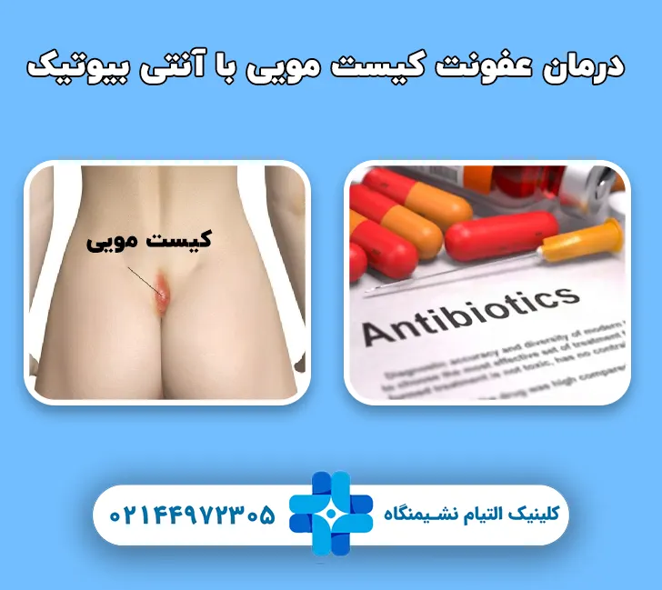 درمان عفونت کیست مویی با آنتی بیوتیک