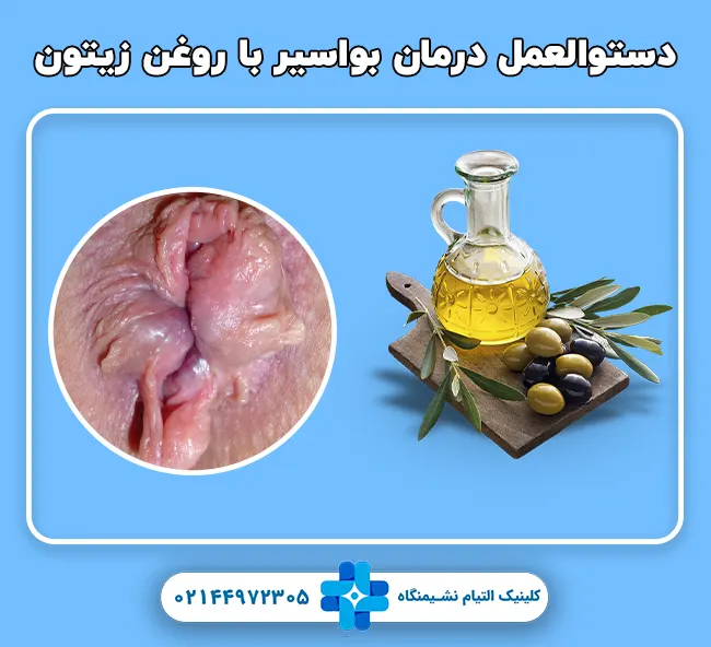 دستوالعمل درمان بواسیر با روغن زیتون در خانه