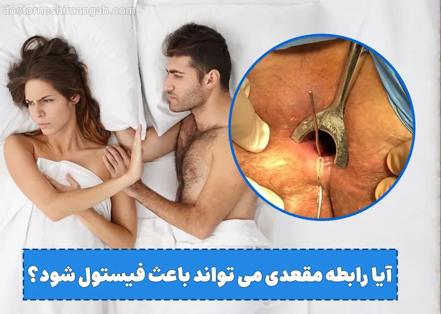 آیا رابطه جنسی مقعدی می تواند باعث فیستول شود؟