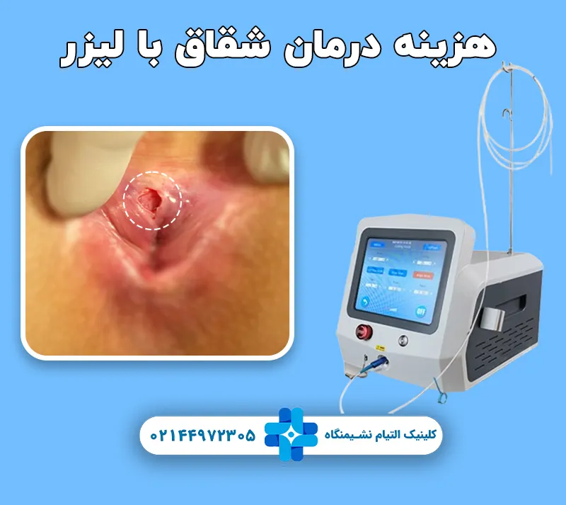 هزینه درمان شقاق با لیزر