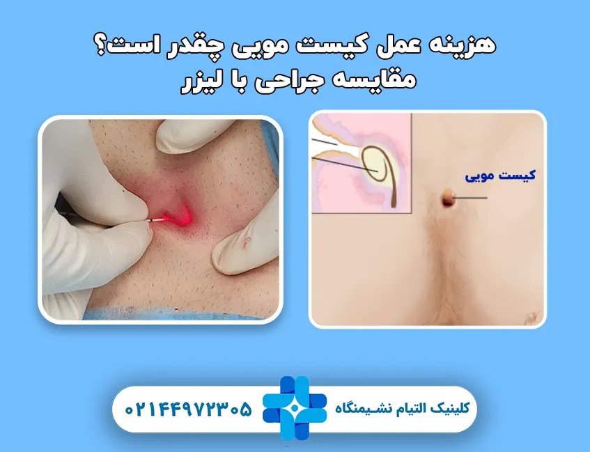 هزینه عمل کیست مویی چقدر است؟ مقایسه جراحی با لیزر