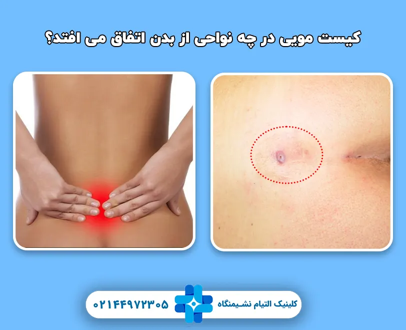 کیست مویی در چه نواحی از بدن اتفاق می افتد؟