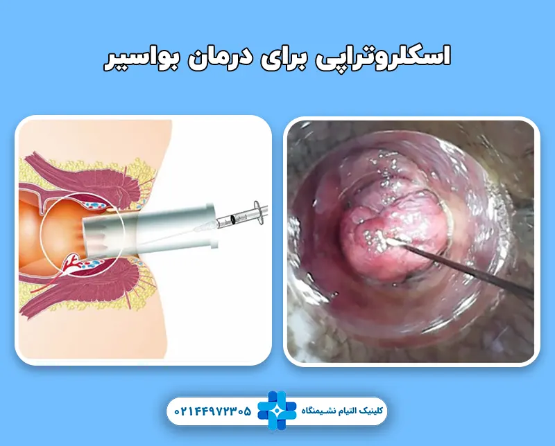 اسکلروتراپی بواسیر