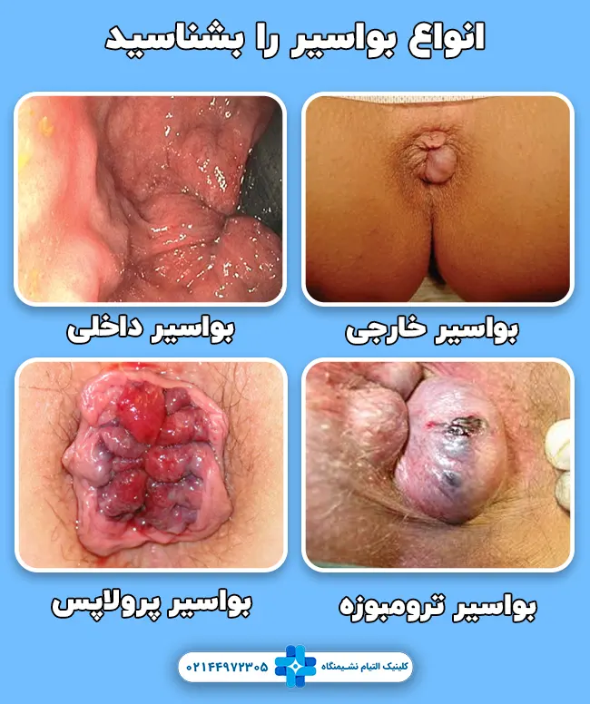 انواع بواسیر را بشناسید