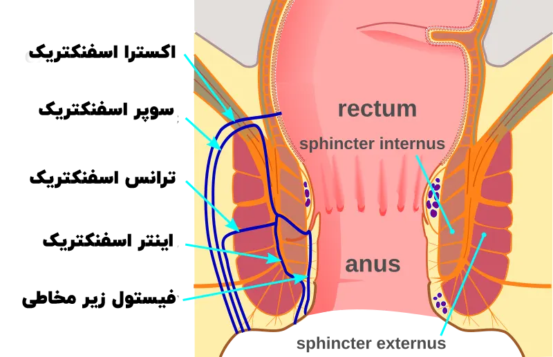 انواع فیستول مقعدی