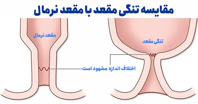 تنگی مقعد چیست