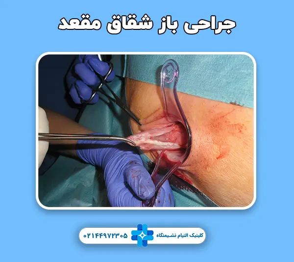 جراحی باز شقاق