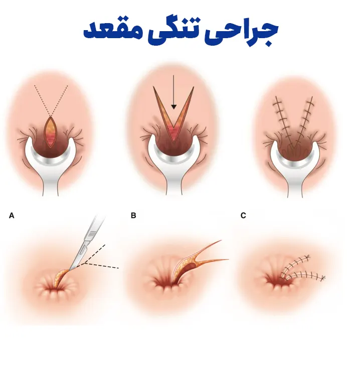 جراحی تنگی مقعد