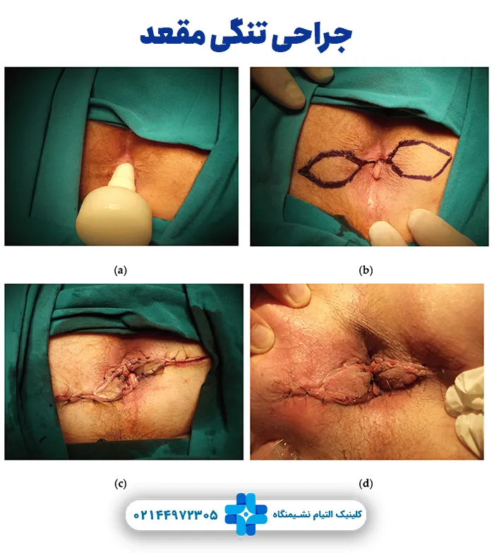 جراحی تنگی مقعد