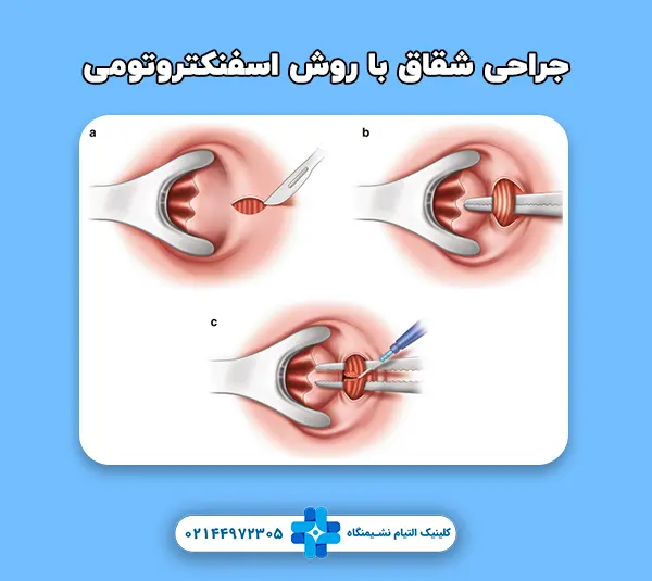 جراحی شقاق با روش اسفنکتروتومی