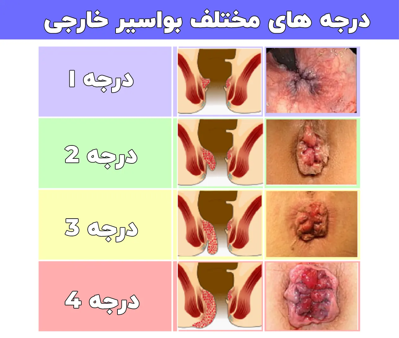 درجه های مختلف بواسیر خارجی