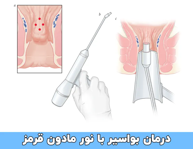 درمان بواسیر با نور مادون قرمز