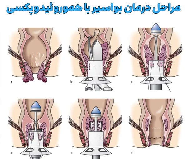 مراحل درمان بواسیر با هموروئیدوپکسی