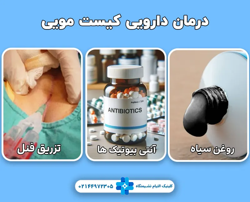 درمان دارویی کیست مویی