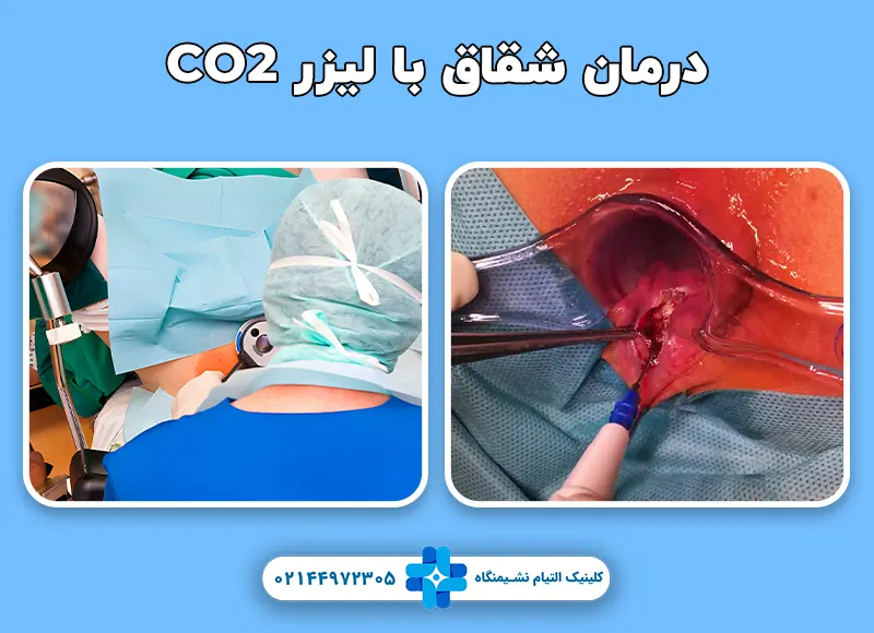 درمان شقاق با لیزر Co2