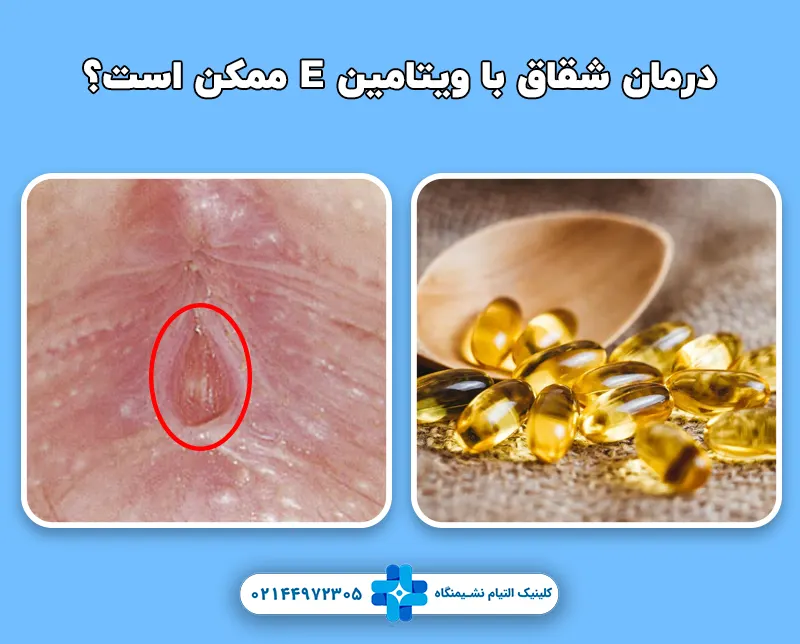 درمان شقاق با ویتامین ای