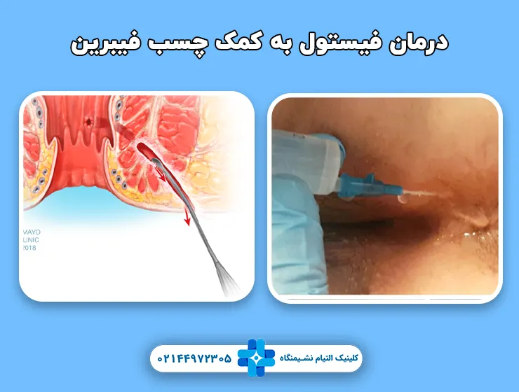 درمان فیستول به کمک چسب فیبرین