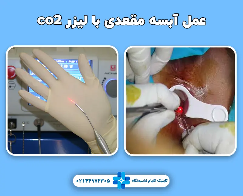 عمل آبسه مقعدی با لیزر co2