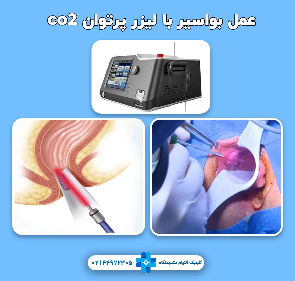 عمل بواسیر با لیزر پرتوان co2