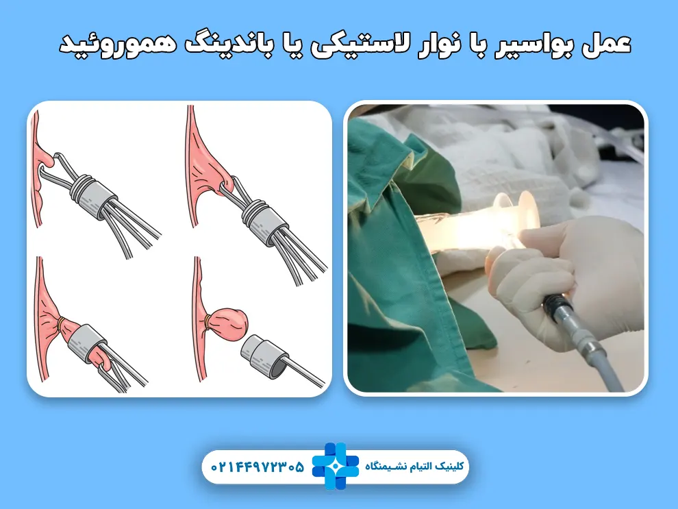 عمل بواسیر با نوار لاستیکی یا باندینگ هموروئید