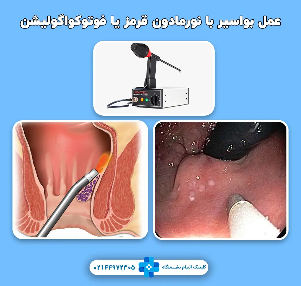 عمل بواسیر با نورمادون قرمز یا فوتوکواگولیشن
