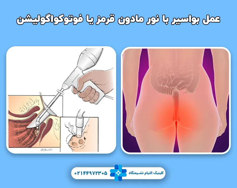 درمان بواسیر با نور مادون قرمز