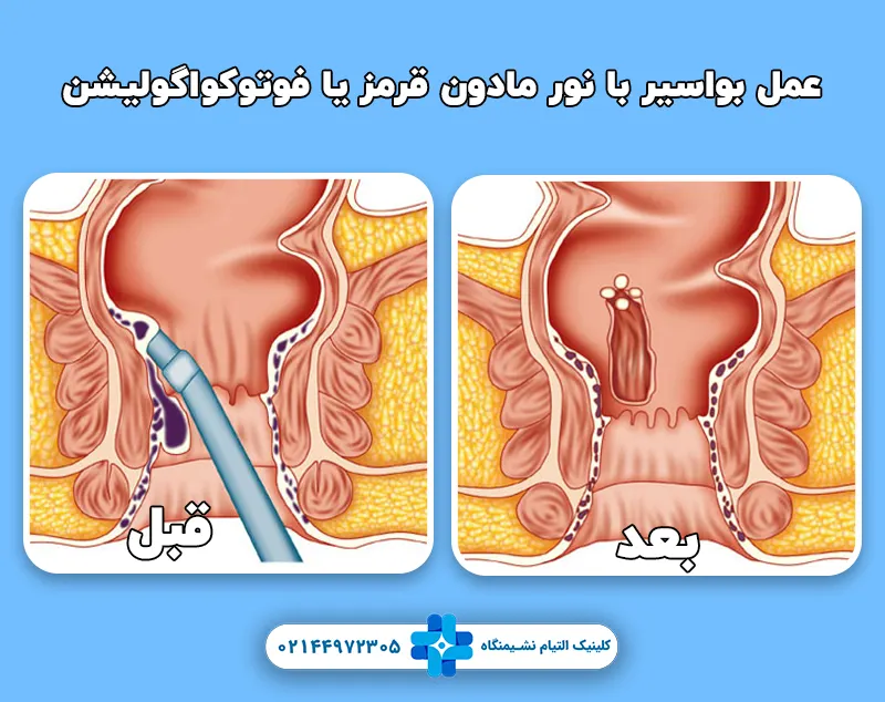 عمل بواسیر با فوتوکواگولیشن