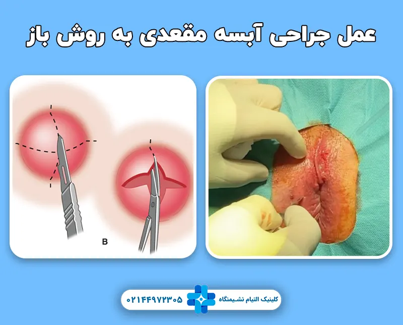 عمل جراحی آبسه مقعدی به روش باز