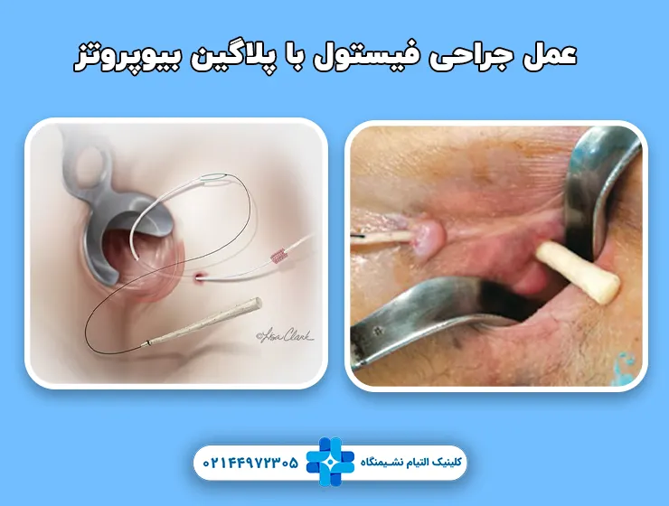 عمل جراحی فیستول با پلاگین بیوپروتز