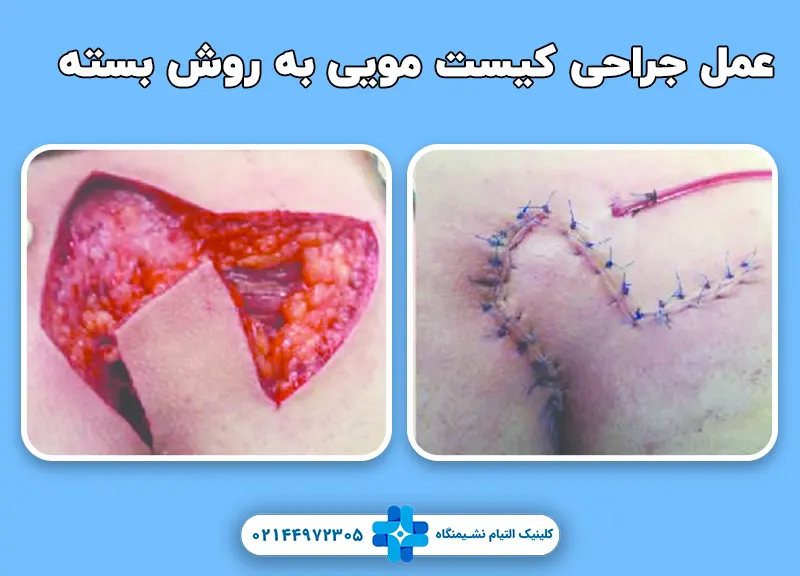 عمل جراحی کیست مویی به روش بسته