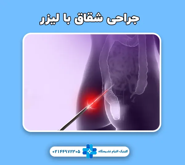عمل شقاق با لیزر