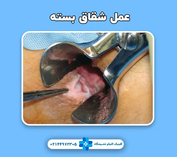 عمل شقاق بسته