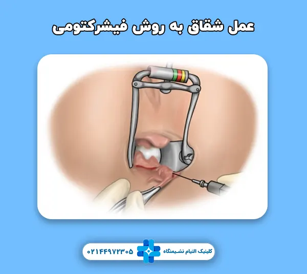 عمل شقاق به روش فیشرکتومی