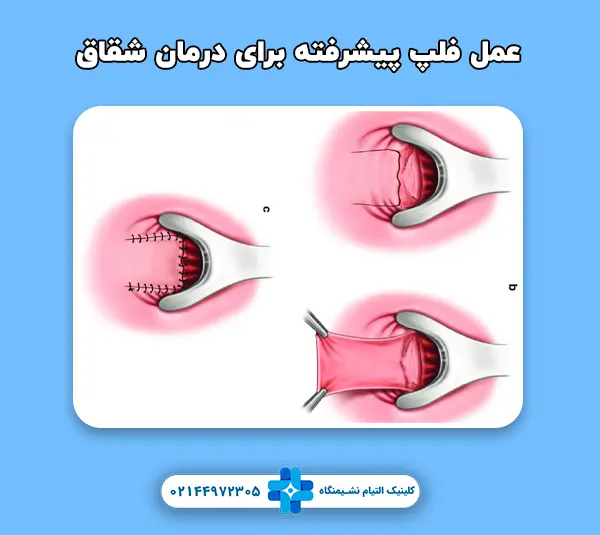 عمل فلپ پیشرفته برای درمان شقاق