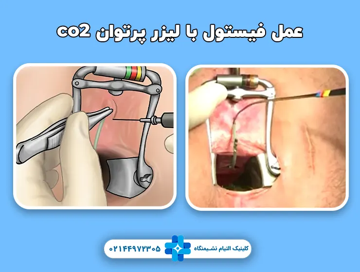 عمل فیستول با لیزر پرتوان co2