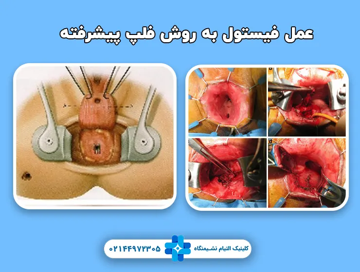 عمل فیستول به روش فلپ پیشرفته