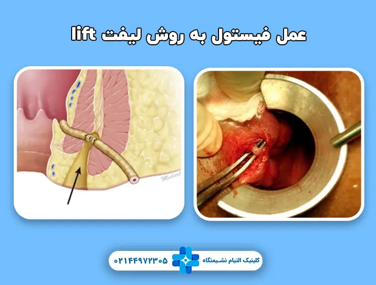 عمل فیستول به روش لیفت lift
