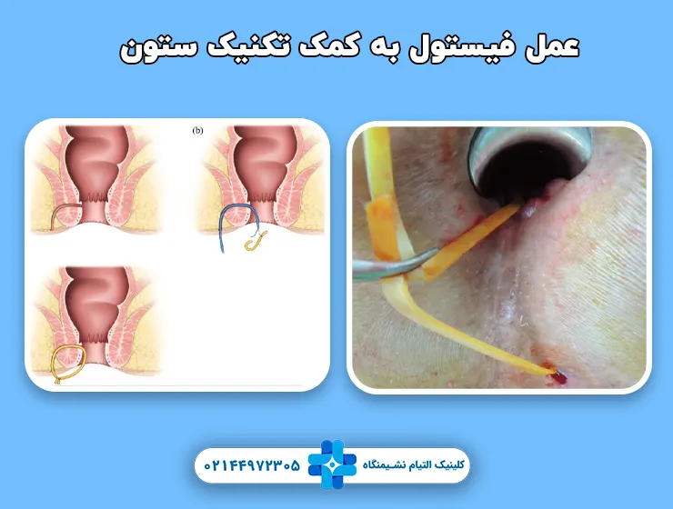 عمل فیستول به کمک تکنیک ستون