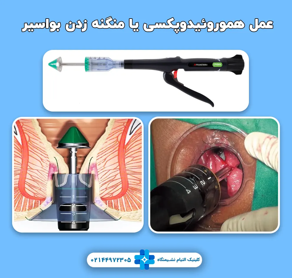 عمل هموروئیدوپکسی یا منگنه زدن بواسیر