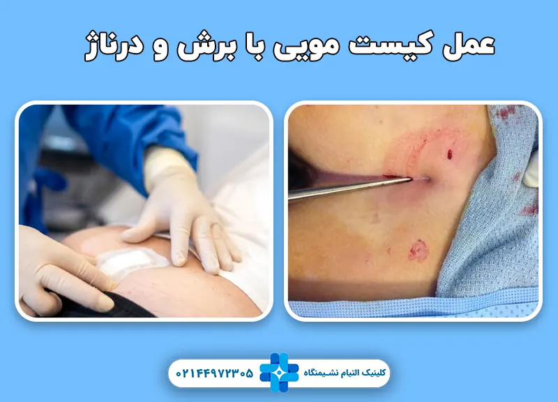 عمل کیست مویی با برش و درناژ