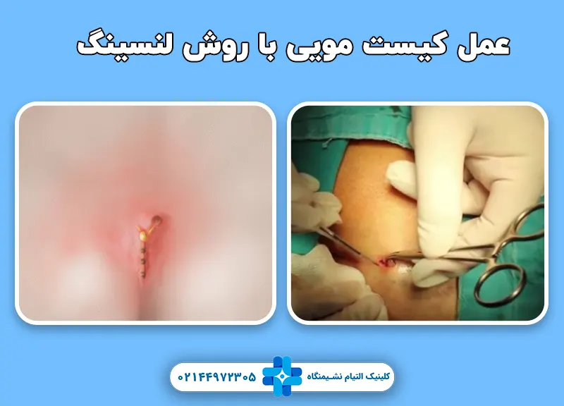 عمل کیست مویی با روش لنسینگ