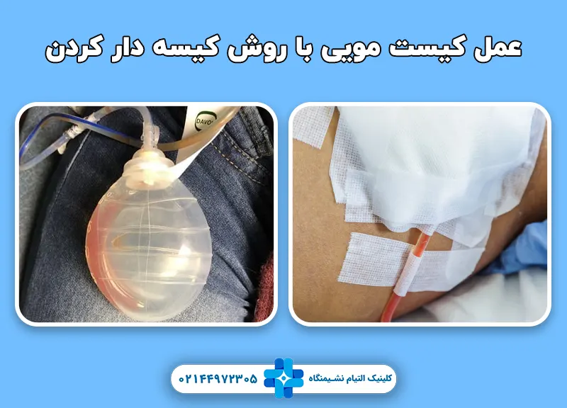 عمل کیست مویی با  روش کیسه ‌دار کردن