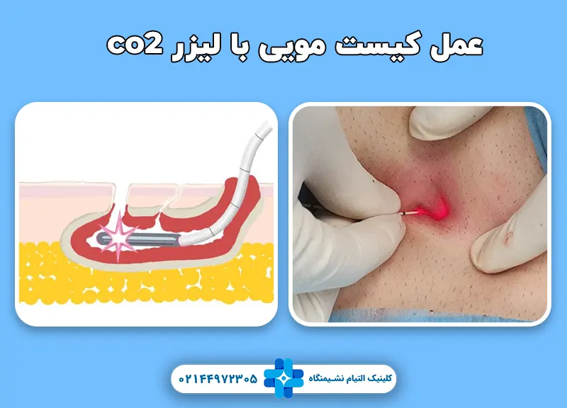 عمل کیست مویی با لیزر co2