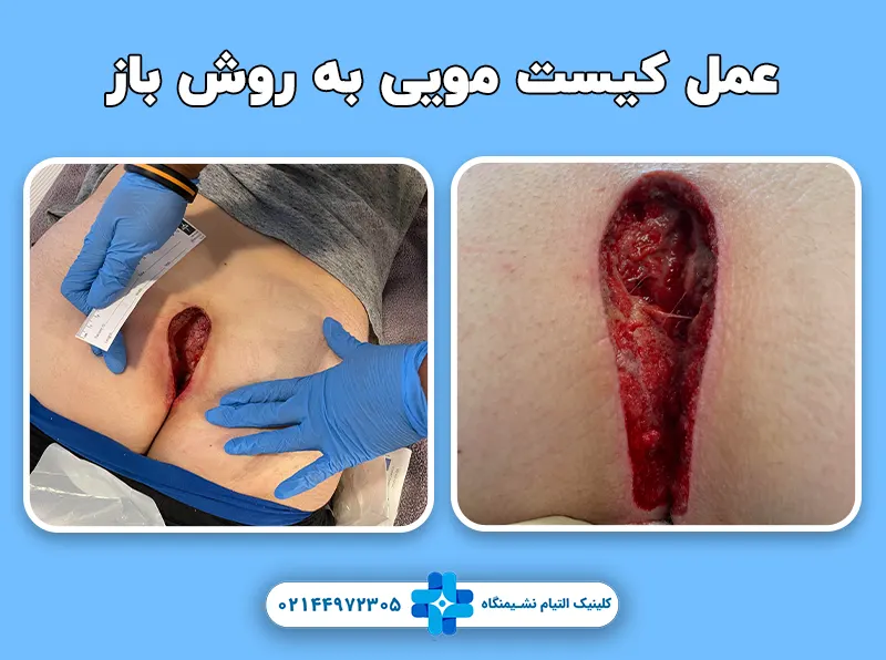 عمل باز کیست مویی