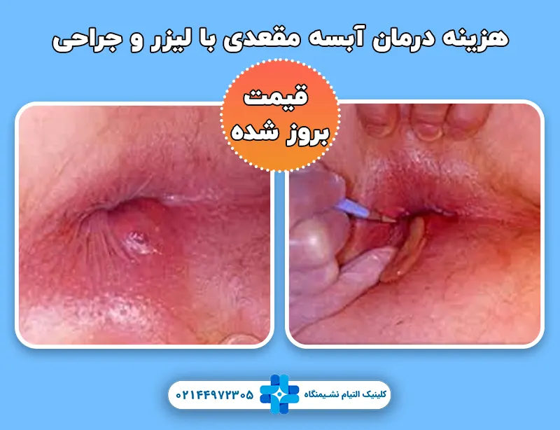هزینه درمان آبسه مقعدی