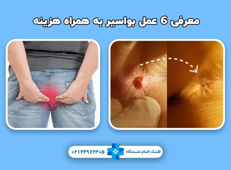 معرفی 6 عمل بواسیر به همراه هزینه آن در سال 1403