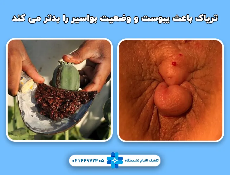 درمان بواسیر با تریاک